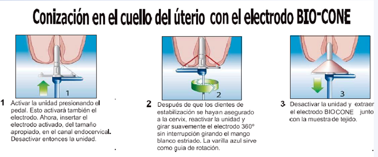 Electrodos rotacionales para conización con dientes de fijación, distribuido por Suministros Galeno