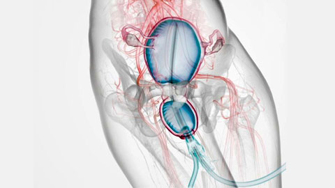Sistema de taponamiento hemorrágico para ginecología, comercializado por Suministros Galeno